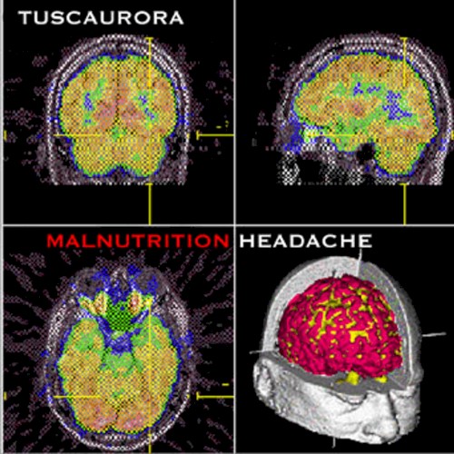 Malnutrition Headache