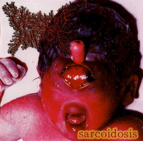 Sarcoidosis