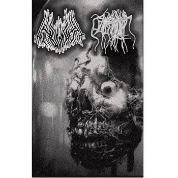 Pathogenesis / Parasitic Twin