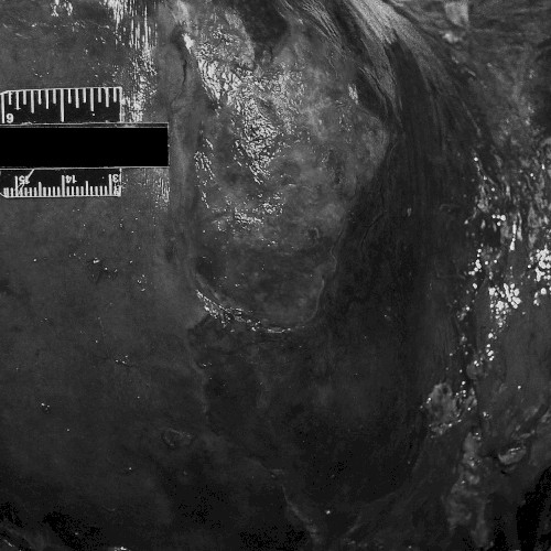 Massive Hepatic Necrosis Following Repeated Isoflurane Exposure