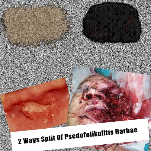 2 Ways Split Of Psedofolikulitis Barbae