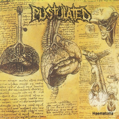 Haematoma