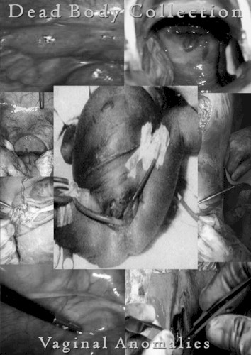 Vaginal Anomalies