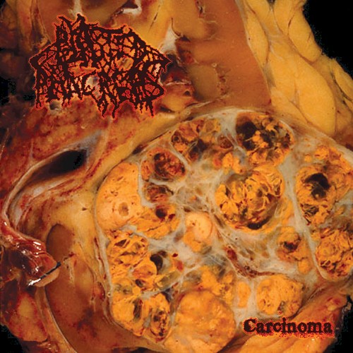 Carcinoma
